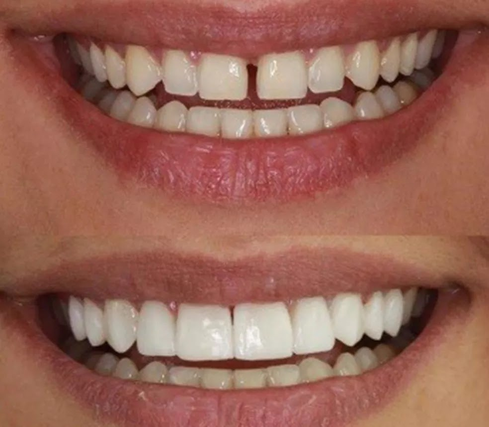 Lente de contato dental resina porcelana Tudo que você precisa